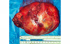 Granulosa Cell Tumor, with a ruler indicating its size
