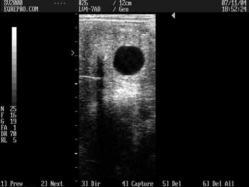 14-day pregnancy ultrasound image