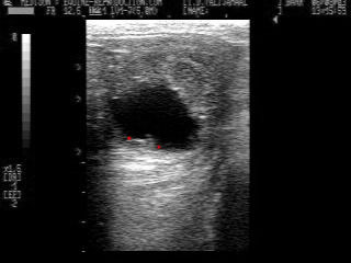 23 day pregnancy ultrasound image