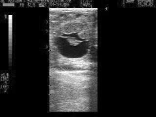 33 day pregnancy ultrasound image