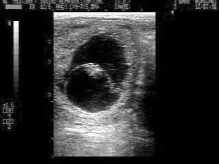 35 day pregnancy ultrasound image