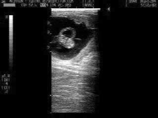 39 day pregnancy ultrasound image
