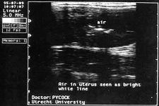 Ultrasound image of hyperechogenic reflections appearing at the opposed lumenal surfaces of the uterine body. The reflections are caused by air in the uterine body.