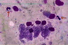 Stained endometrial smear showing inflammatory cells (neutrophils, arrowed) and endometrial cells.