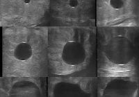 Early conceptus ultrasound images