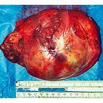 Most Common Ovarian Tumor