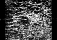 Luteinized Unruptured Follicle Ultrasound