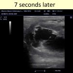 Ultrasound Examples of the Normal and Abnormal Ovulation