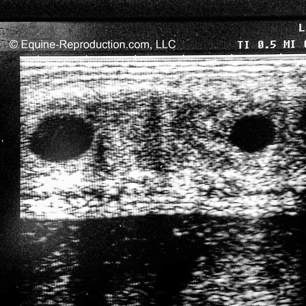 Twins per Ultrasound