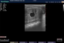 Day 12 pregnancy per ultrasound