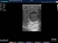 16 day pregnancy per ultrasound