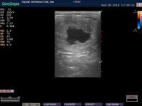 21 day pregnancy per ultrasasound