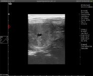 Repeated Embryo Loss in Mares