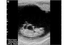 Day 60 pregnancy per ultrasound