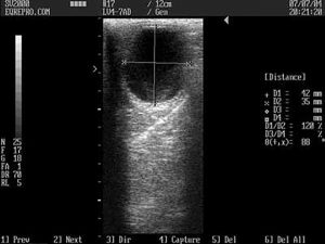 Ultrasound showing different width and heoght on a follicle