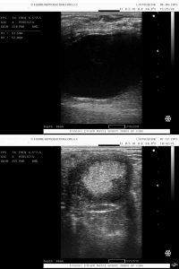 Follicle and CL compared per ultrasound
