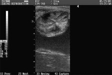 Uterine Edema per Ultrasound