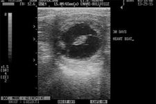 30 day pregnancy per ultrasound